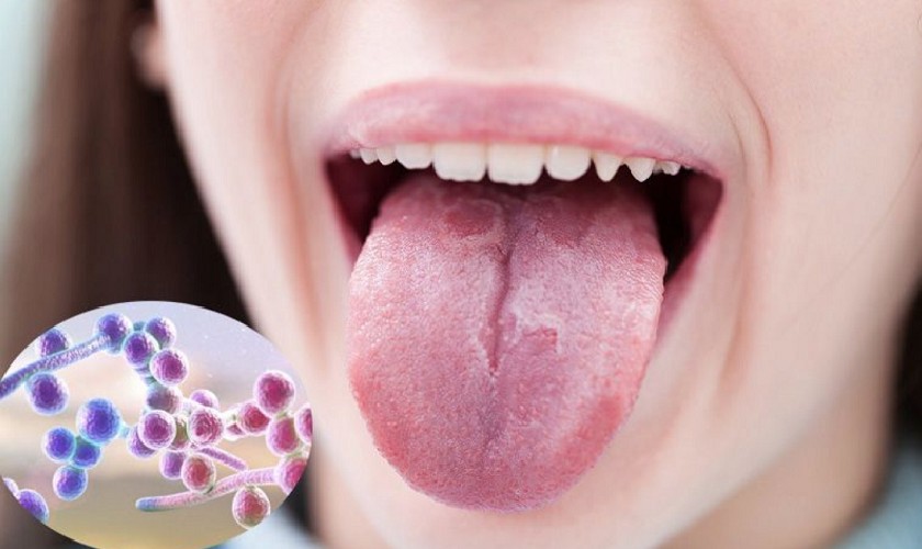 Bệnh nấm miệng gây ra bởi nấm Candida