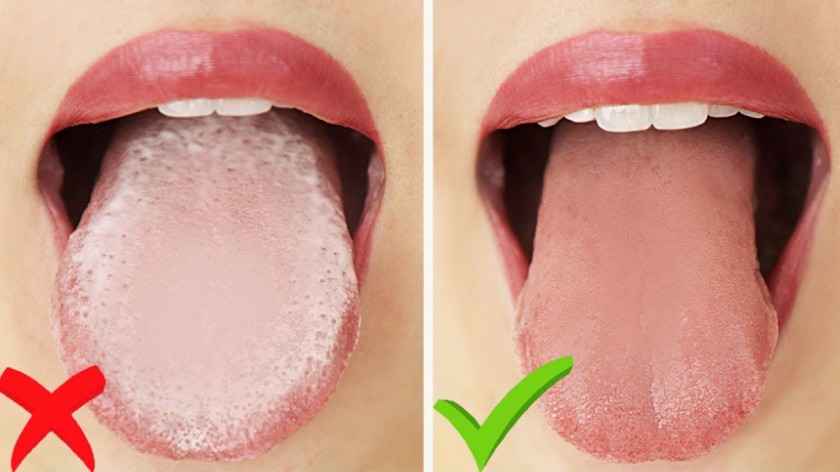 Bật mí cách làm sạch lưỡi tại nhà giúp hơi thở thơm mát