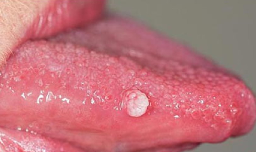 Mụn mọc ở lưỡi có thể là dấu hiệu của sùi mào gà