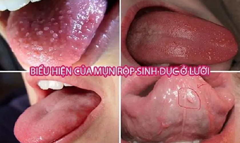 Mụn rộp sinh dục là căn bệnh do virus HPV gây ra