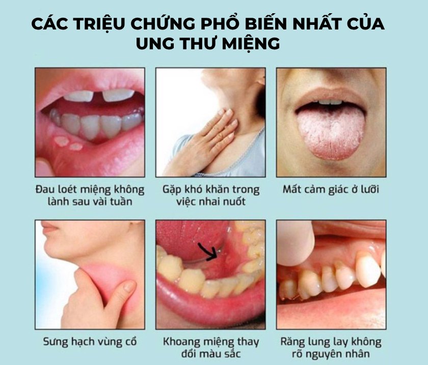 Những dấu hiệu của ung thư khoang miệng