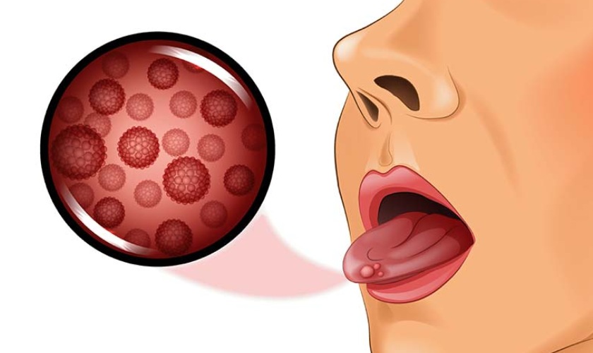 Lưỡi mọc mụn cần thăm khám bác sĩ chuyên khoa để được tư vấn điều trị