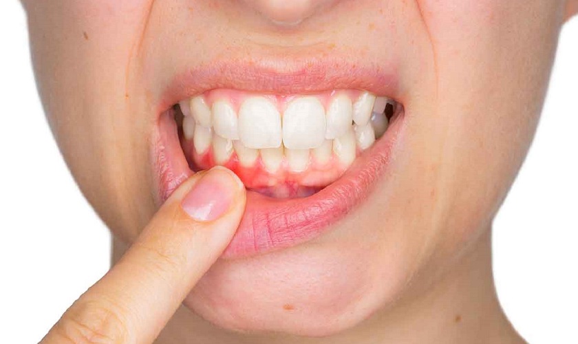 Một số mẹo chữa viêm chân răng tại nhà đơn giản, hiệu quả