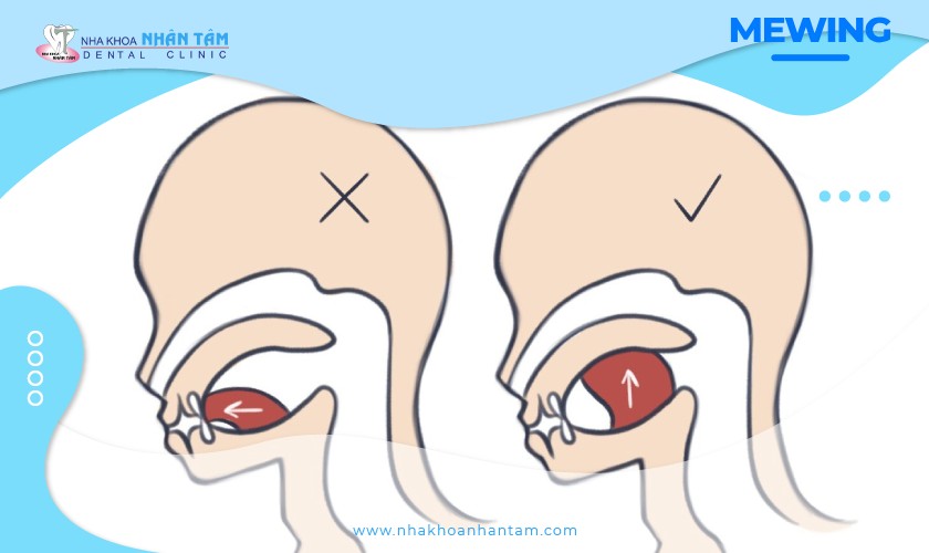 Mewing – Phương pháp cải thiện cấu trúc khuôn mặt tự nhiên