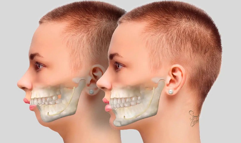 Hô hàm có thể luyện tập Mewing