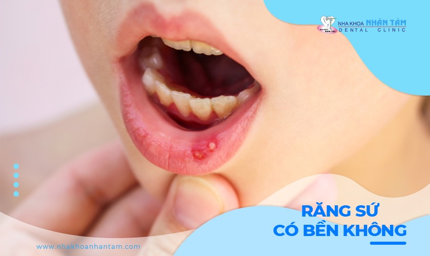 Top 5 miếng dán nhiệt miệng hiệu quả nhanh chóng