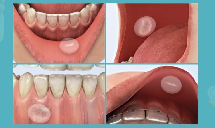 Miếng dán nhiệt miệng giúp giảm đau rát, khó chịu cho người bệnh