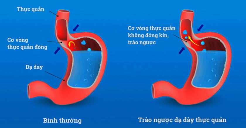 Trào ngược dạ dày thực quản gây ra vị đắng trong miệng