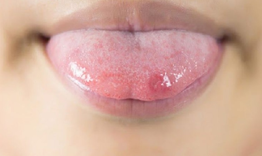 Hình ảnh nhiệt lưỡi ở vùng đầu lưỡi