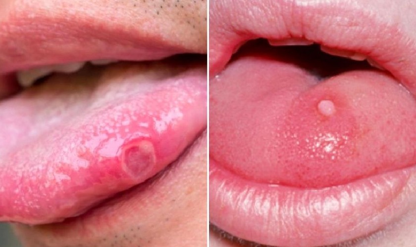 Tình trạng nhiệt lưỡi