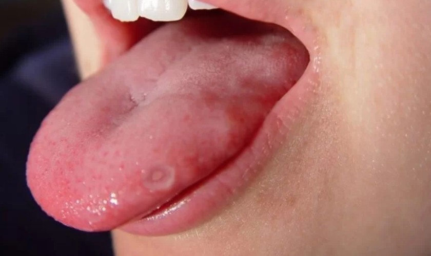 Hình ảnh trẻ bị nhiệt lưỡi