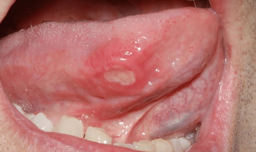 Vết loét xuất hiện bên dưới lưỡi
