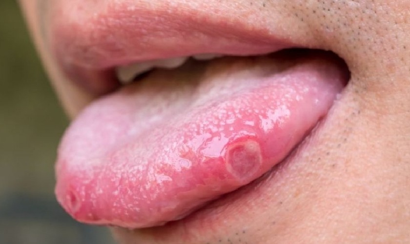 Nhiệt lưỡi tạo một hình tròn trên lưỡi