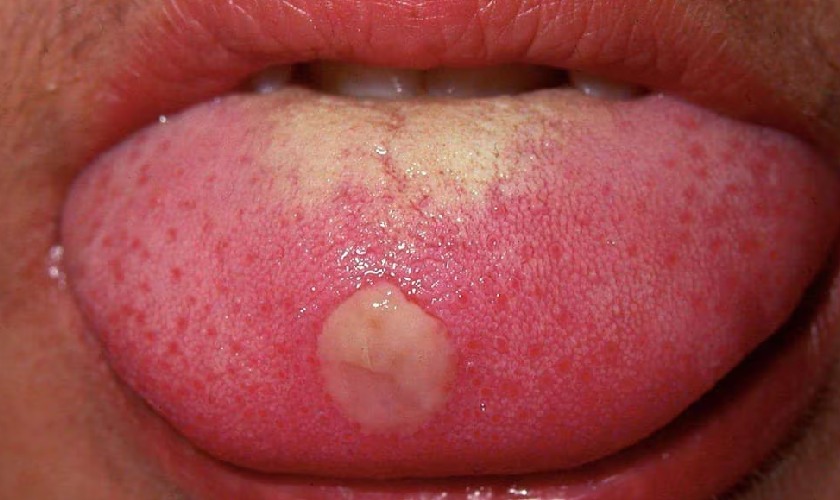 Nhiệt lưỡi gây đau rát, ăn uống khó khăn