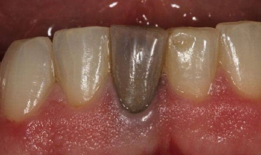 Răng bị viêm tủy thường có màu xám đen