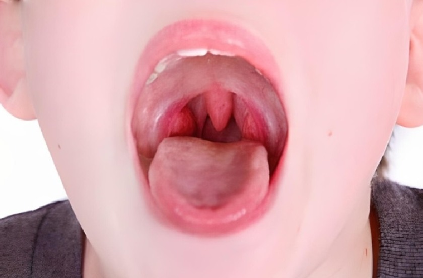 Niêm mạc miệng khỏe mạnh