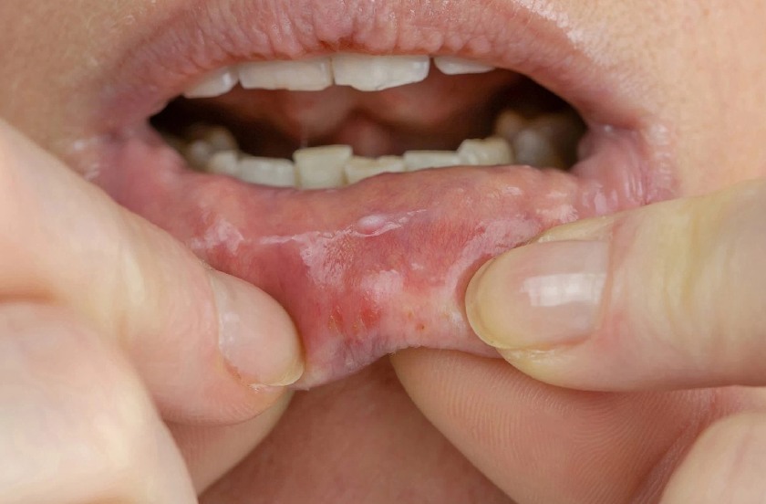 Niêm mạc miệng bị viêm, lở loét