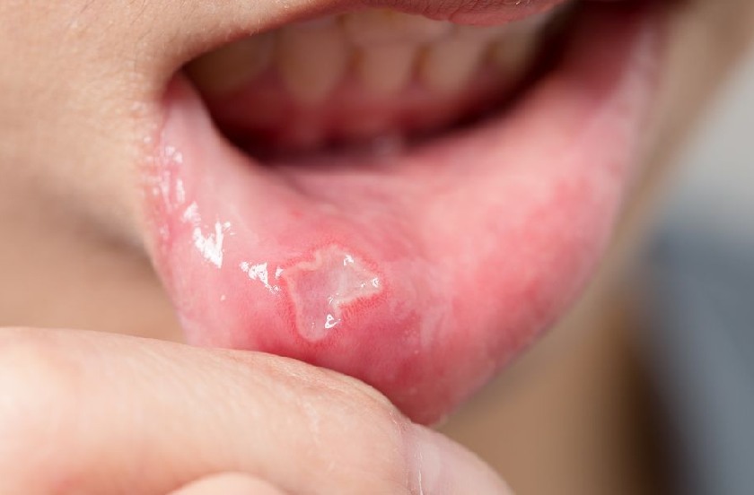 Viêm niêm mạc miệng do nhiều nguyên nhân gây nên