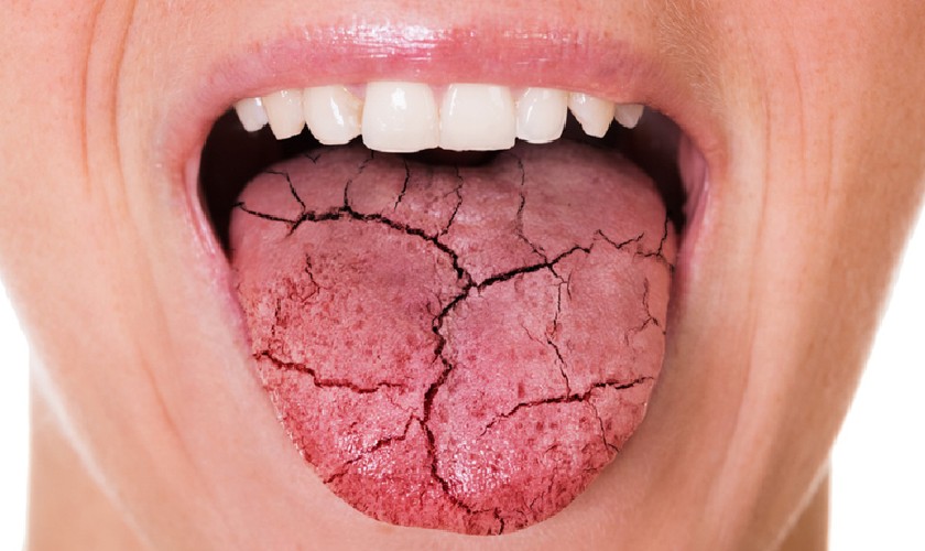 Khô miệng khiến vi khuẩn phát triển và gây mùi hôi khó chịu