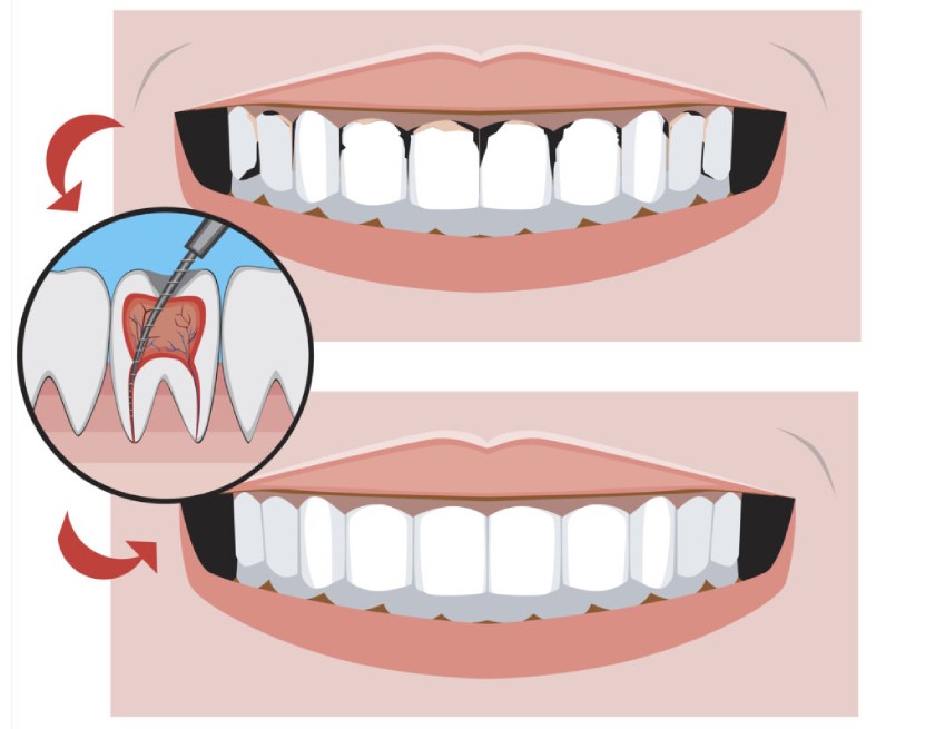 Điều trị viêm tủy sẽ giúp loại bỏ mùi hôi miệng