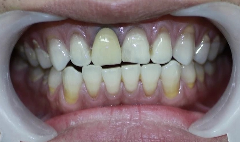 Nướu răng bị đen do sử dụng răng sứ kim loại