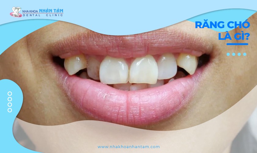 Răng chó là gì? Tướng người răng chó nói lên điều gì?