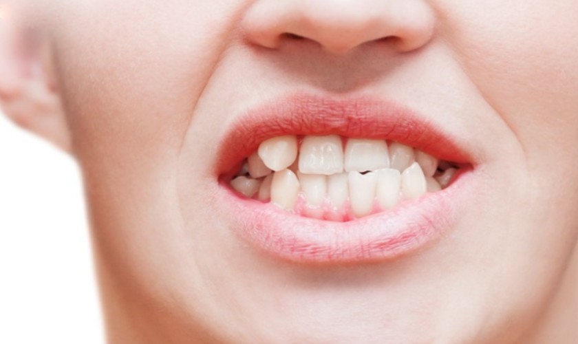 Răng chó là cách gọi dân gian để chỉ những chiếc răng nanh nằm ở hai bên hàm