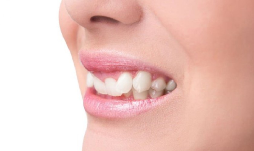 Răng chó do rất nhiều nguyên nhân gây nên