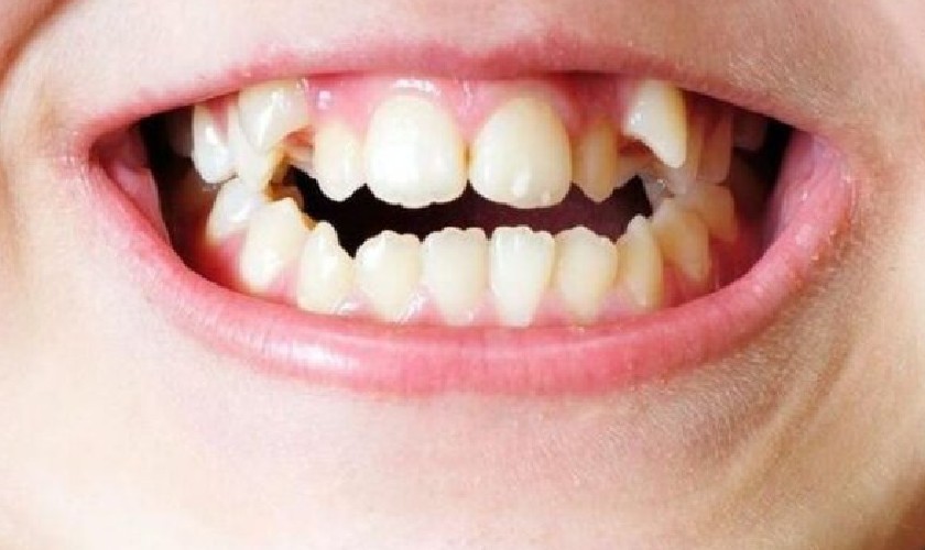 Răng chó khiến nhiều người mất tự tin khi giao tiếp