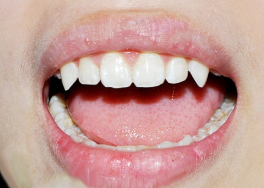 Người có răng chó thường không được đánh giá cao trong nhân tướng học