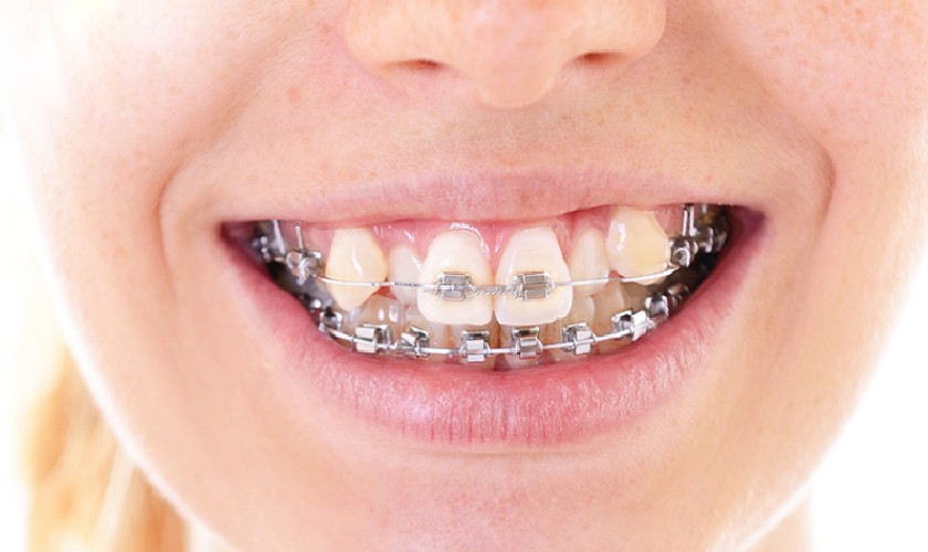 Niềng răng là giải pháp trong những trường hợp răng chó mọc dài, khấp khểnh