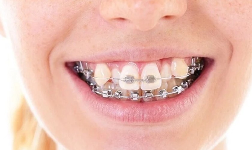 Niềng răng là giải pháp hàng đầu giúp cải thiện răng lòi xỉ