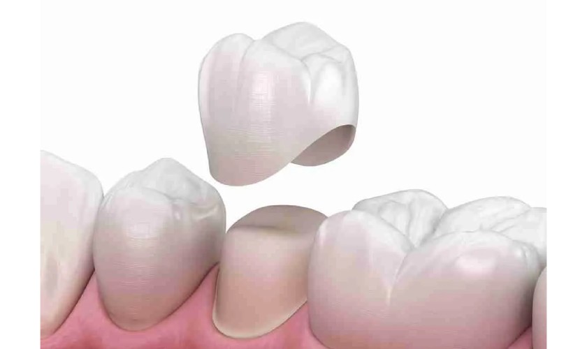 Giải pháp bọc răng sứ