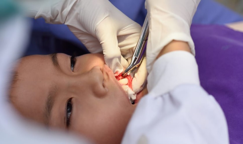 Nhổ răng trong trường hợp cần thiết