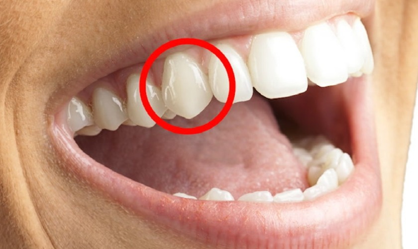 Răng nhọn có vai trò gì trong quá trình ăn nhai và làm việc của cung hàm?
