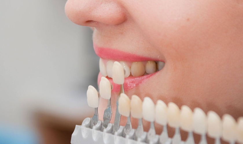 Bọc răng sứ sẽ giúp bạn sở hữu răng nhọn đẹp và an toàn