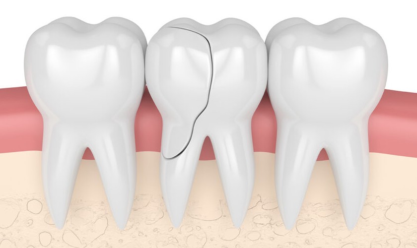 Răng nứt là gì? Những thông tin quan trọng cần biết