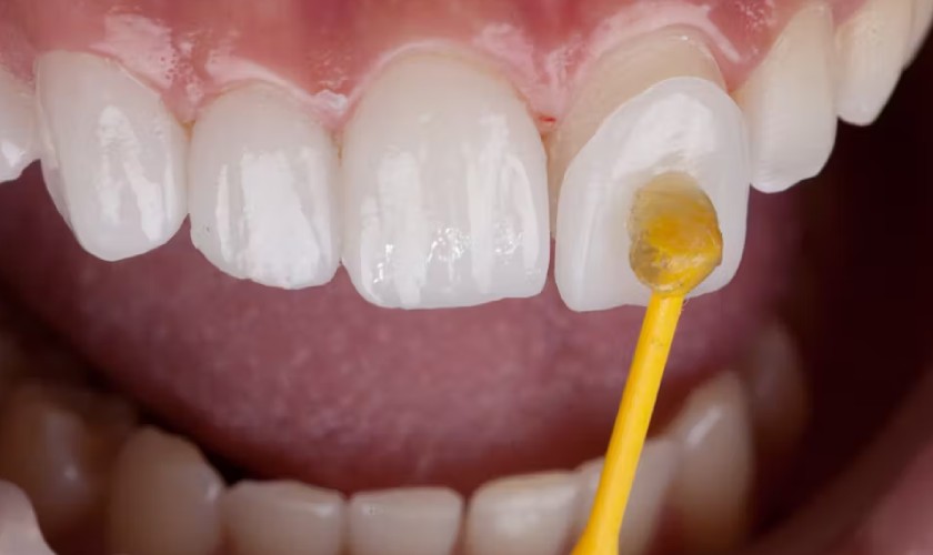 Phương pháp mặt dán sứ Veneer