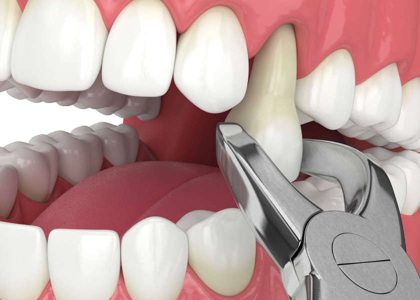 Nhổ răng và trồng răng Implant trong trường hợp răng nứt không thể bảo tồn được nữa