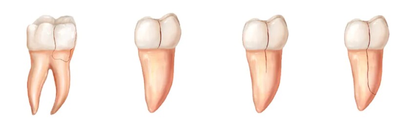Các dạng răng nứt thường gặp