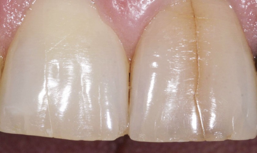 Nứt răng khiến cấu trúc răng bị suy yếu