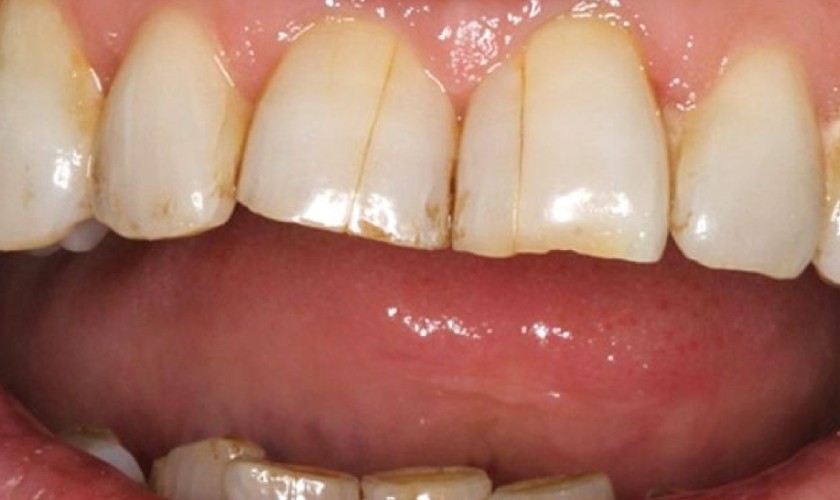 Răng nứt không thể tự lành lại