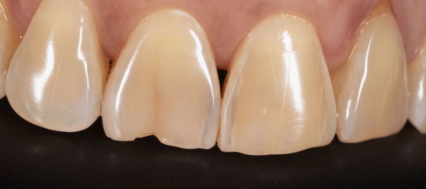 Răng nứt nhẹ cần theo dõi để xử lý kịp thời