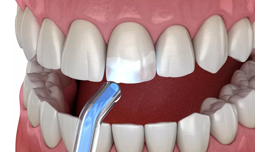 Kỹ thuật trám răng bị nứt