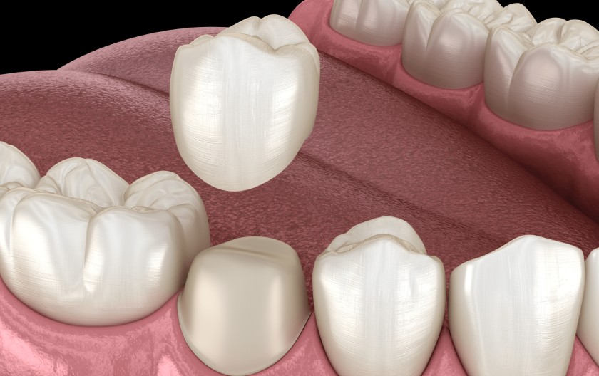 Bọc răng sứ được nhiều người lựa chọn