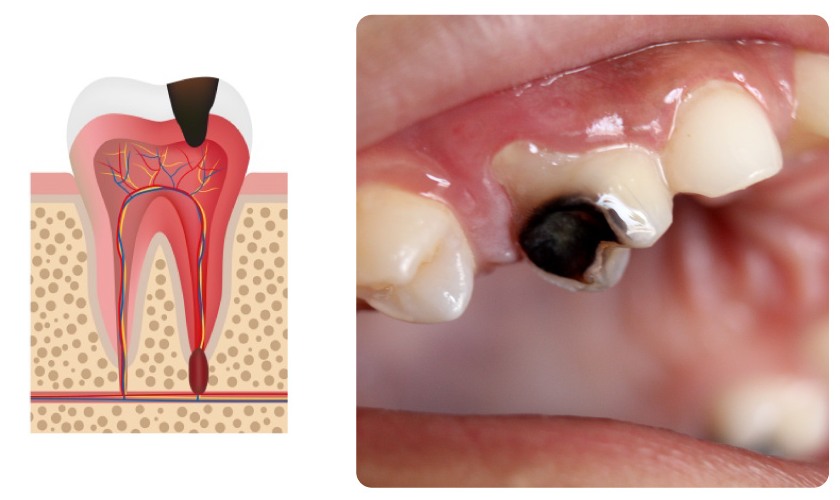 Răng số 4 bị sâu nặng, không phục hồi được sẽ được chỉ định nhổ