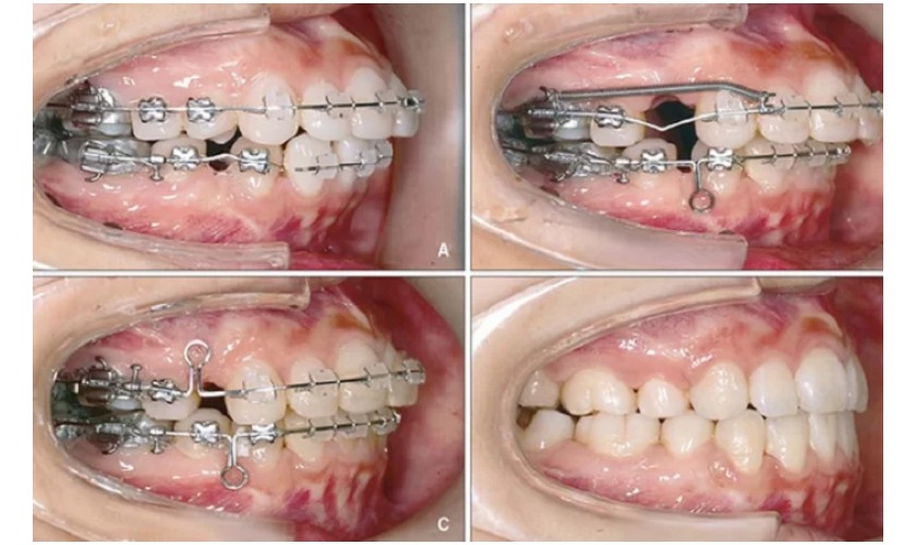 Nhổ răng số 4 để phục vụ cho quá trình niềng răng
