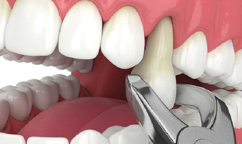 Nhổ răng số 4 có đau không là thắc mắc của nhiều người