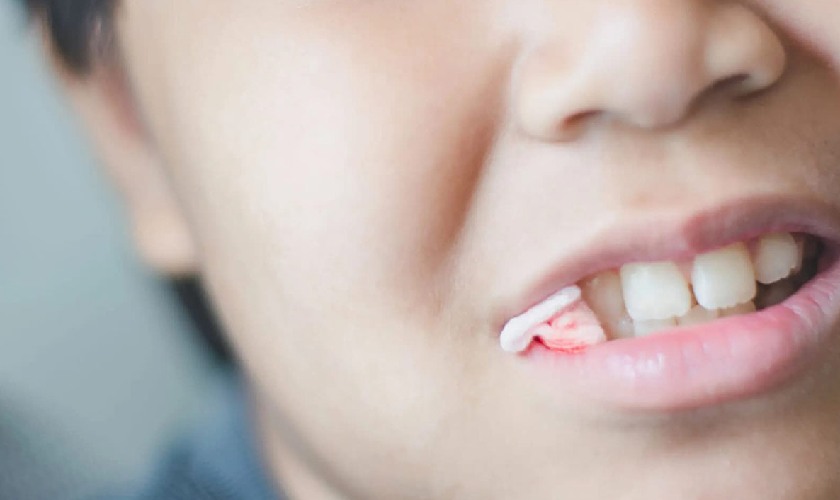 Cắn gạc sau khi nhổ răng để cầm máu