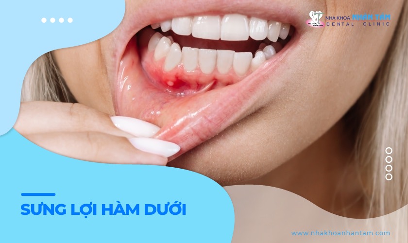 Sưng lợi hàm dưới: Nguyên nhân, triệu chứng và cách điều trị